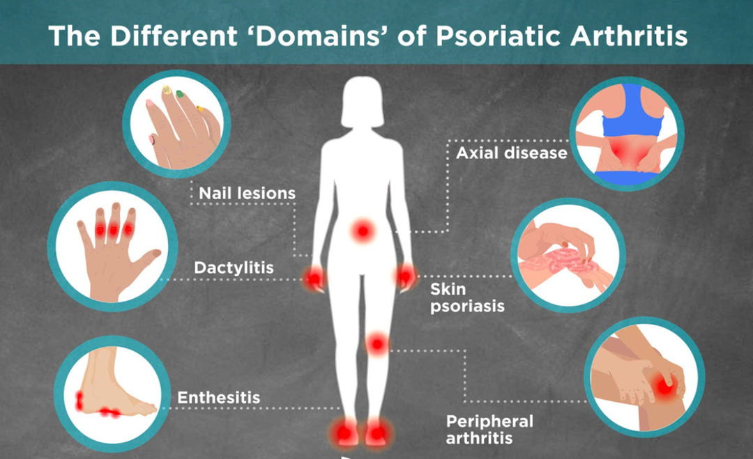 STOP PSORIATIC ARTHRITIS PAIN NATURALLY - STRONGEST PSORIATIC PAIN KILLER - MADE IN USA