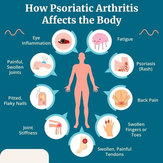 STOP PSORIATIC ARTHRITIS PAIN NATURALLY - STRONGEST PSORIATIC PAIN KILLER - MADE IN USA