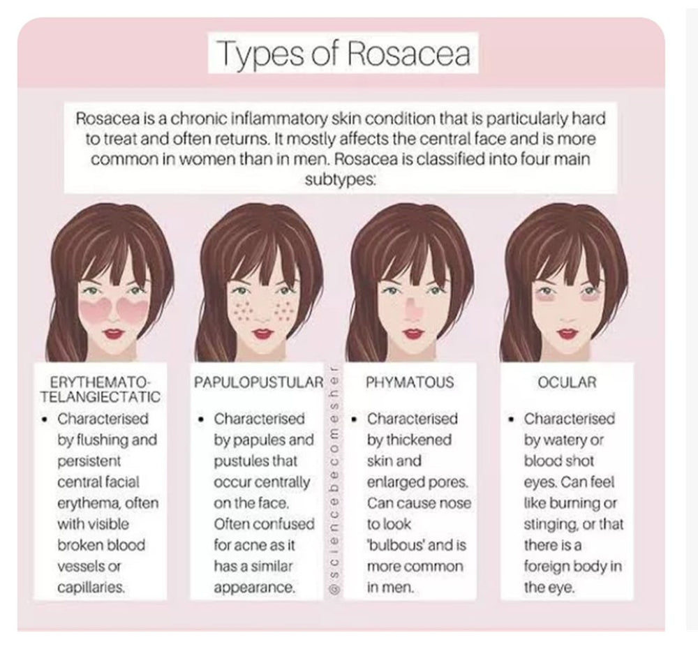 GET RID OF ROSACEA SKIN DISEASE - REDUCE SCALING & ITCHING - MADE IN USA