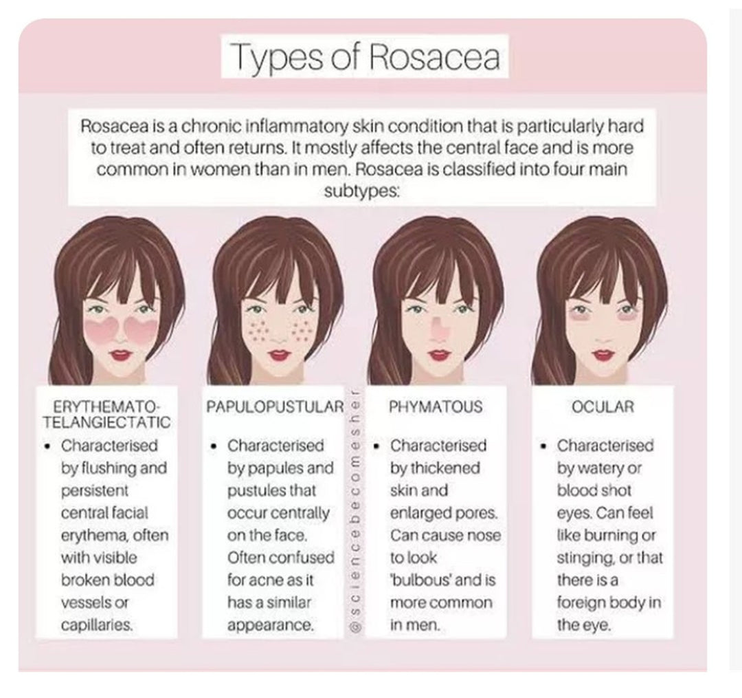 GET RID OF ROSACEA SKIN DISEASE - REDUCE SCALING & ITCHING - MADE IN USA