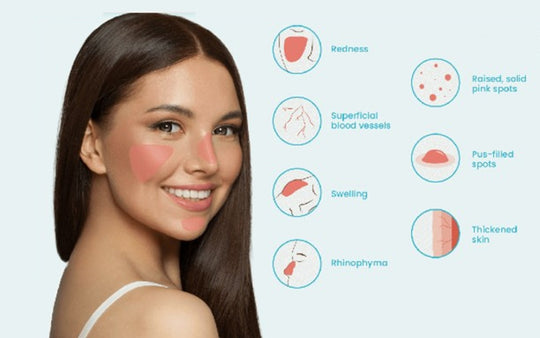 GET RID OF ROSACEA SKIN DISEASE - REDUCE SCALING & ITCHING - MADE IN USA