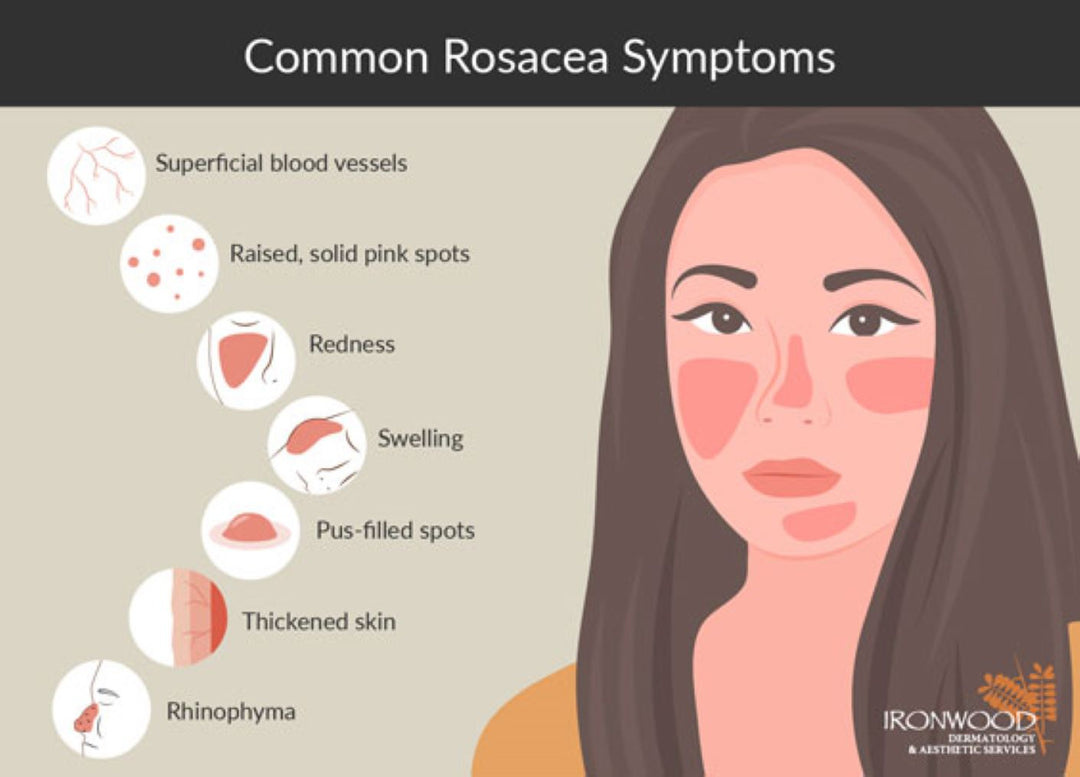 GET RID OF ECZEMA, ROSACEA & PSORIASIS NATURALLY - Prevent and Treat - MADE IN USA