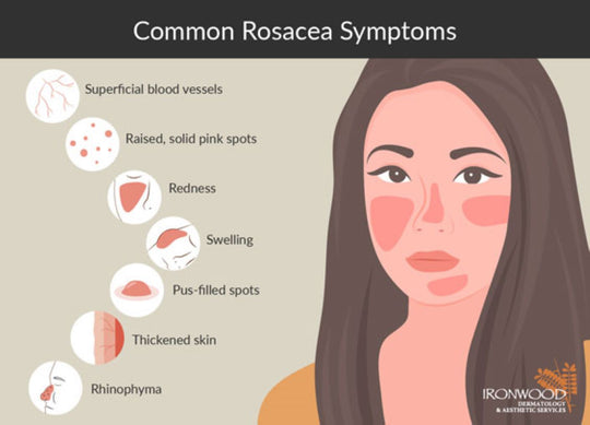 GET RID OF ECZEMA, ROSACEA & PSORIASIS NATURALLY - Prevent and Treat - MADE IN USA