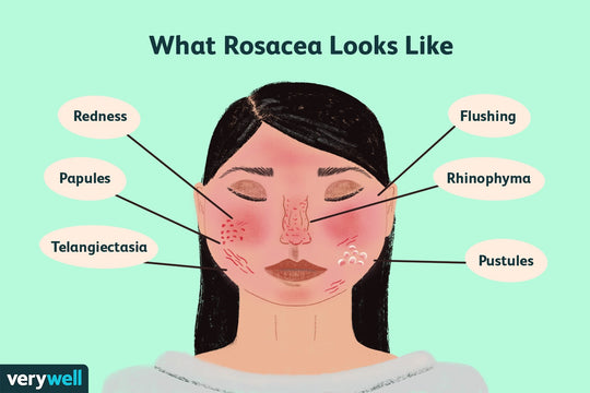 GET RID OF ECZEMA, ROSACEA & PSORIASIS NATURALLY - Prevent and Treat - MADE IN USA