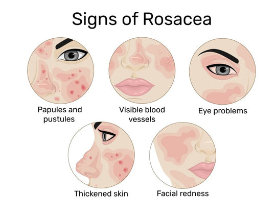 GET RID OF ROSACEA SKIN DISEASE - REDUCE SCALING & ITCHING - MADE IN USA