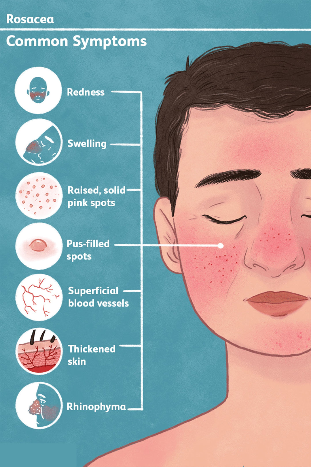 GET RID OF ECZEMA, ROSACEA & PSORIASIS NATURALLY - Prevent and Treat - MADE IN USA