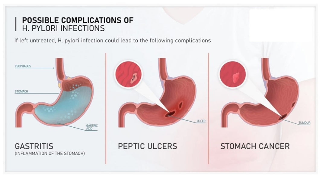 ELIMINATE STOMACH BACTERIA H PYLORI RIGHT AWAY - STRONGEST HERBAL FORMULA - GUMMIES - M ADE IN USA