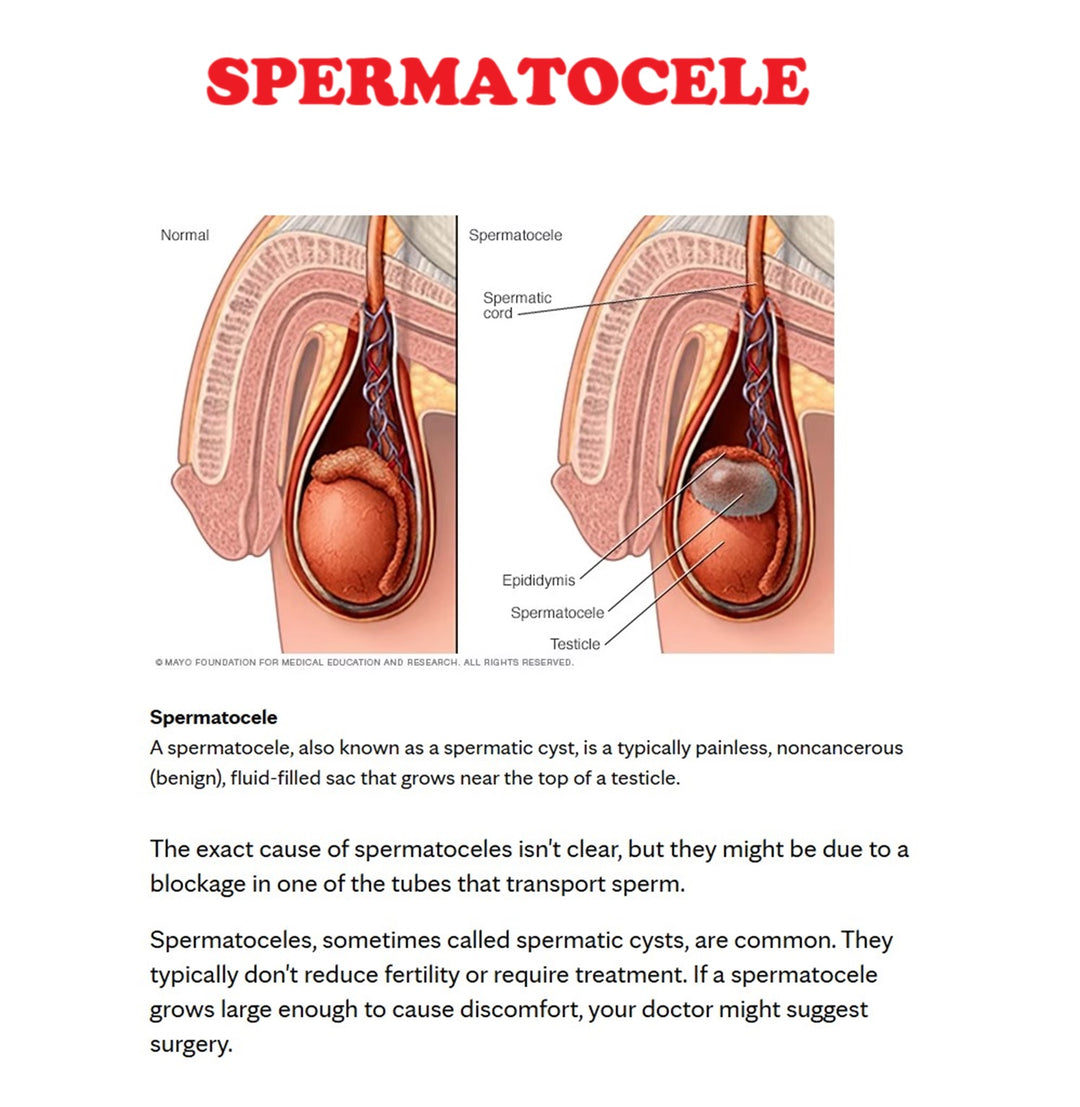 GET RID OF TESTICULAR CYST NATURALLY - STRONGEST TESTICULAR PAIN KILLER - Made in USA