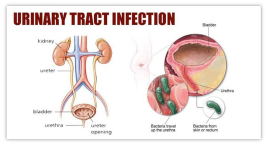 GET RID OF URINARY TRACT INFECTION - ELIMINATE THE URINARY BACTERIAL INFECTION - TREAT & PREVENT - GUMMIES MADE IN USA