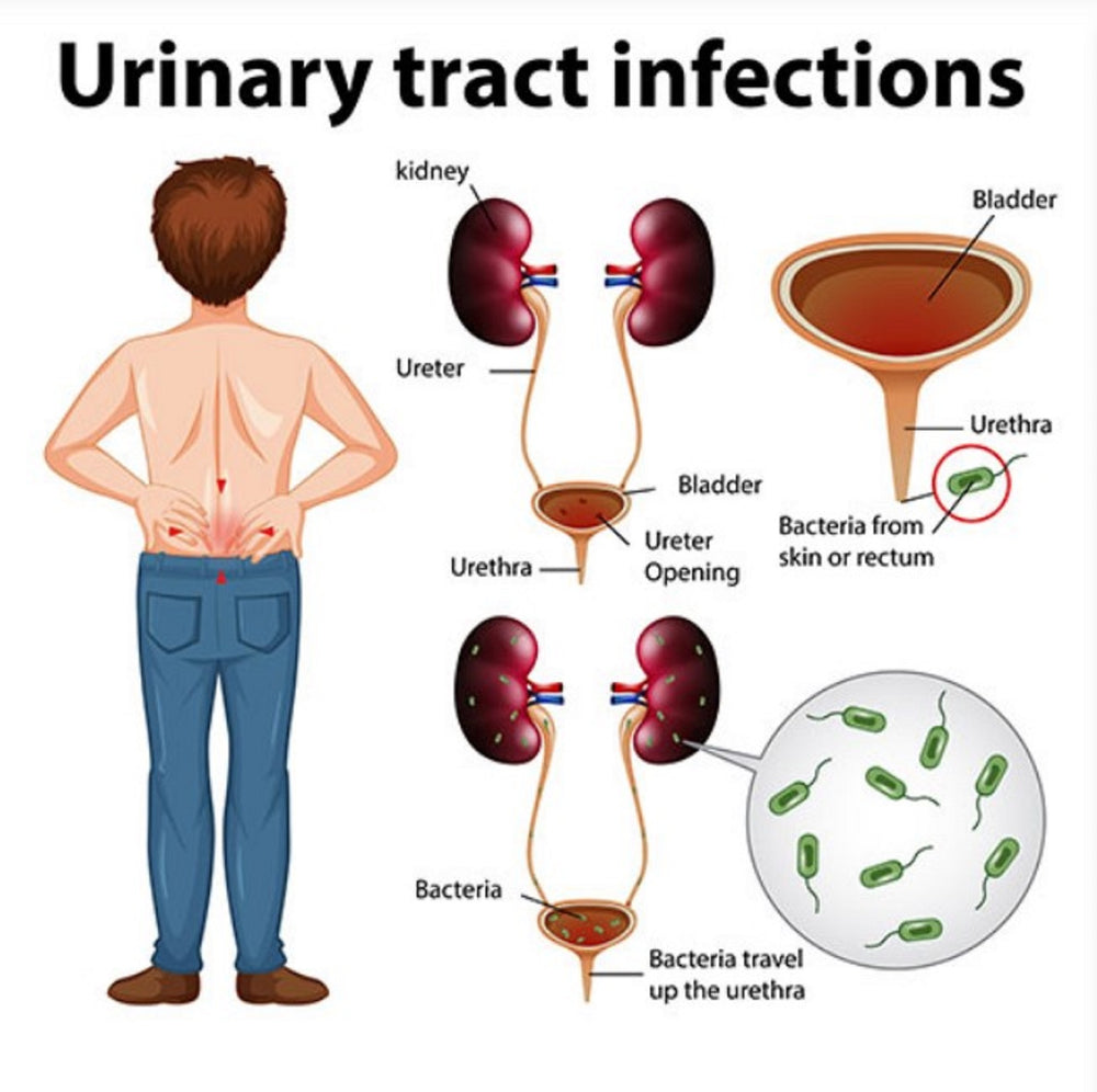 GET RID OF URINARY TRACT INFECTION NATURALLY  - ELIMINATE URINARY BACTERIAL INFECTION -TREAT & PREVENT - MADE IN USA