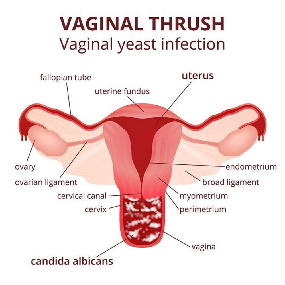 ELIMINAR LOS HONGOS VAGINALES Y CANDIDIASIS - matar los hongos y candidiasis naturalmente - MADE IN USA