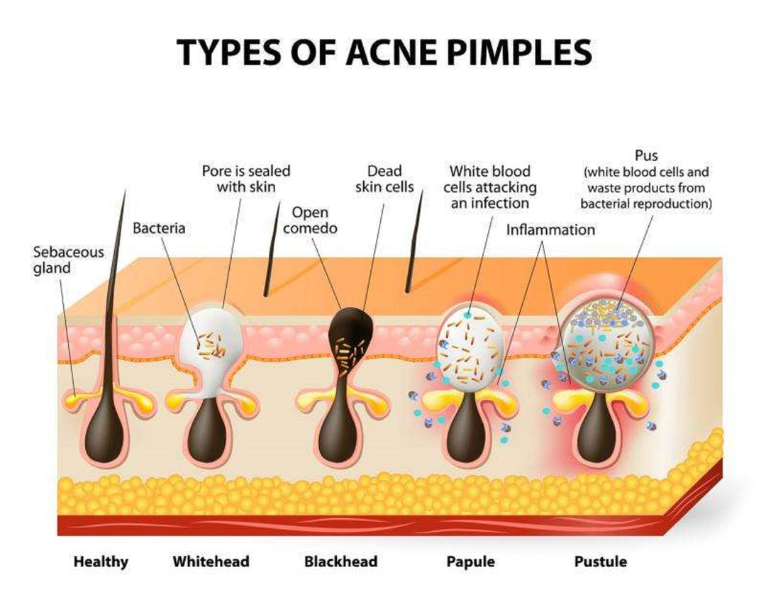 GET RID OF ACNE BACTERIA- ANTI ACNE - REMOVE ANY ACNE FROM YOUR FACE - GUMMIES - Made in USA