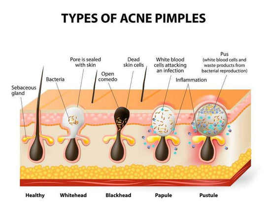 GET RID OF ACNE BACTERIA TREATMENT FOR MEN & WOMEN - Made in USA - 100% Natural
