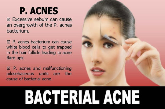 GET RID OF ACNE BACTERIA- ANTI ACNE - REMOVE ANY ACNE FROM YOUR FACE - GUMMIES - Made in USA