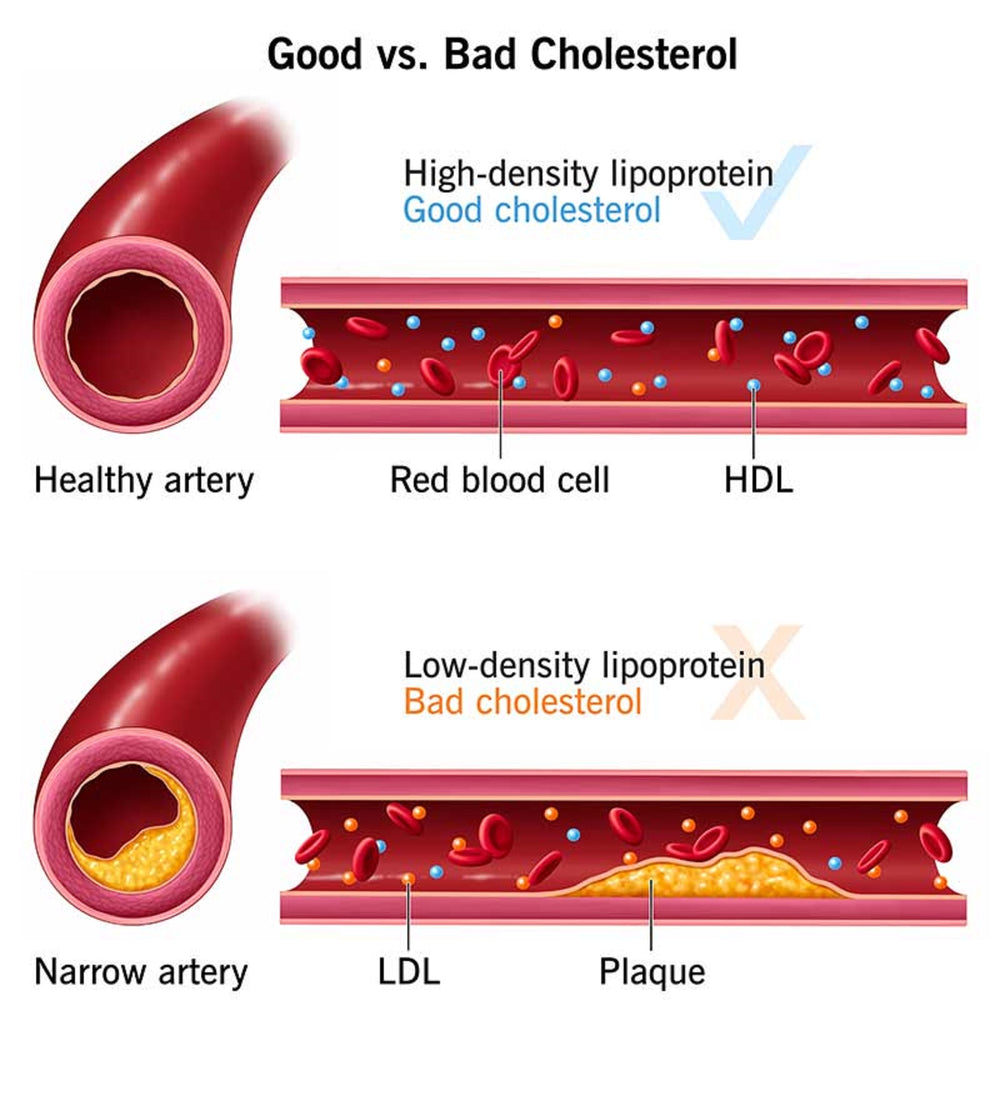 GET RID OF BAD CHOLESTEROL & HIGH TRIGLYCERIDES - REMOVE & FLUSH OUT - MADE IN USA
