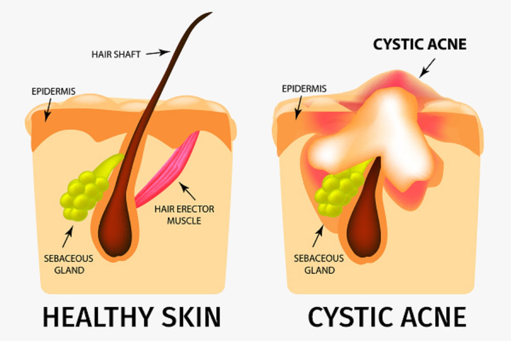 GET RID OF CYSTIC ACNE BACTERIAL - REMOVE ANY CYST ACNE FROM YOUR FACE - Made in USA