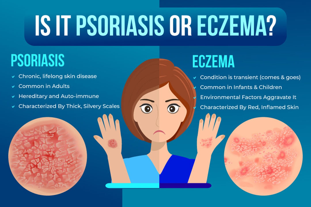 GET RID OF ECZEMA SKIN DISEASE - REDUCE SCALING & ITCHING - MADE IN USA