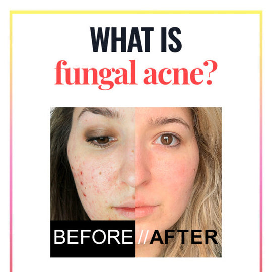 GET RID OF FUNGAL ACNE  - ELIMINATE ANTI FUNGAL ACNE INFECTION - MADE IN USA