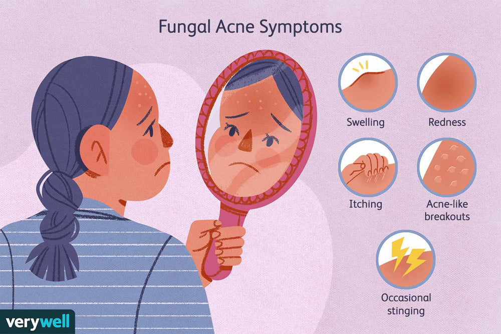 GET RID OF FUNGAL ACNE  - ELIMINATE ANTI FUNGAL ACNE INFECTION - MADE IN USA
