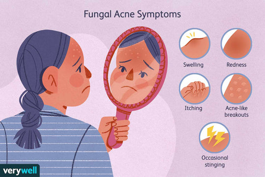 GET RID OF FUNGAL ACNE  - ELIMINATE ANTI FUNGAL ACNE INFECTION - MADE IN USA