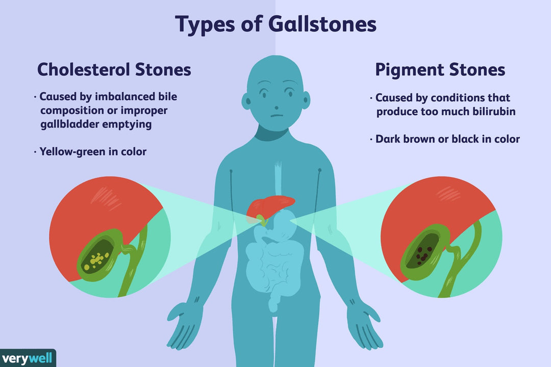 GET RID OF GALLBLADDER STONES & KIDNEY STONES - HERBAL STONES BREAKER - MADE IN USA