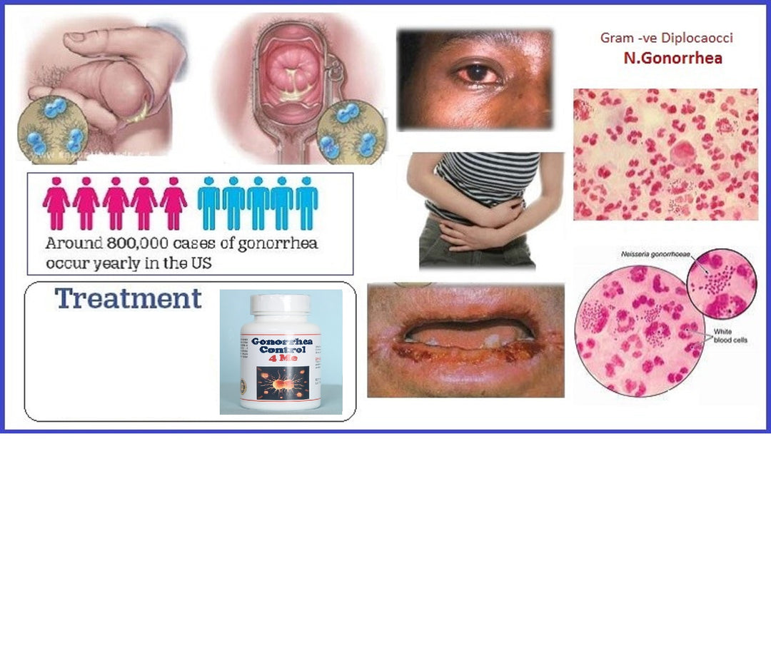 GET RID OF GONORRHEA CHLAMYDIA & PAPILLOMA INFECTION- ANTIBACTERIAL - ANTI INFLAMMATORY - MADE IN USA
