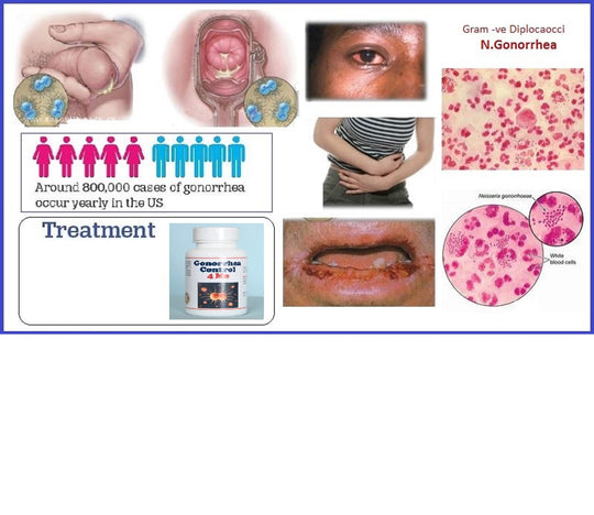 GET RID OF GONORRHEA CHLAMYDIA & PAPILLOMA INFECTION- ANTIBACTERIAL - ANTI INFLAMMATORY - MADE IN USA