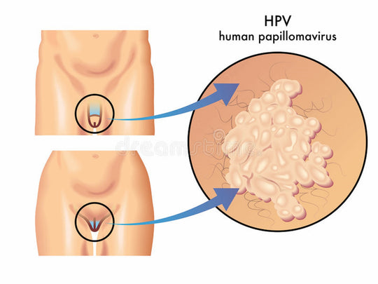 GET RID OF PAPILLOMA HPV NATURALLY - KILL THE PAPILLOMA VIRUS RIGH AWAY - MADE IN USA