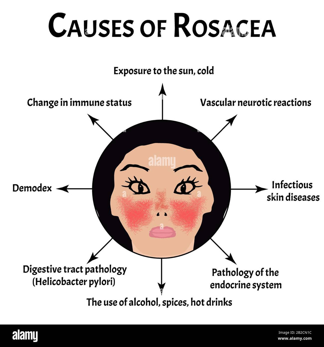 GET RID OF ROSACEA SKIN DISEASE - REDUCE SCALING & ITCHING - MADE IN USA