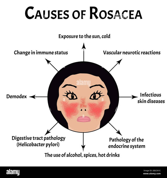 GET RID OF ROSACEA SKIN DISEASE - REDUCE SCALING & ITCHING - MADE IN USA