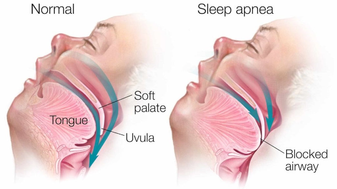 STOP SLEEP APNEA & SNORING RIGHT AWAY - GET RID OF SLEEP APNEA & SNORING NATURALLY - MADE IN USA