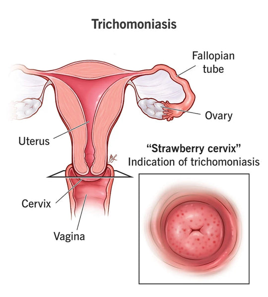 STOP TRICHOMONIASIS TRICH PAIN - EXTRA STRENGTH - STRONGEST PAIN KILLER - MADE IN USA