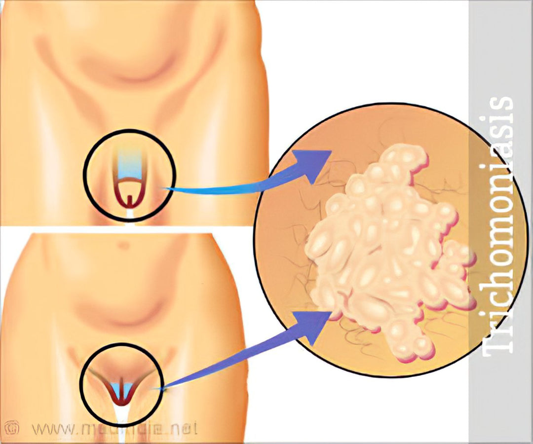 GET RID OF TRICHOMONIASIS VAGINALIS NATURALLY - STRONG ANTI PARASITES GUMMIES - MADE IN USA