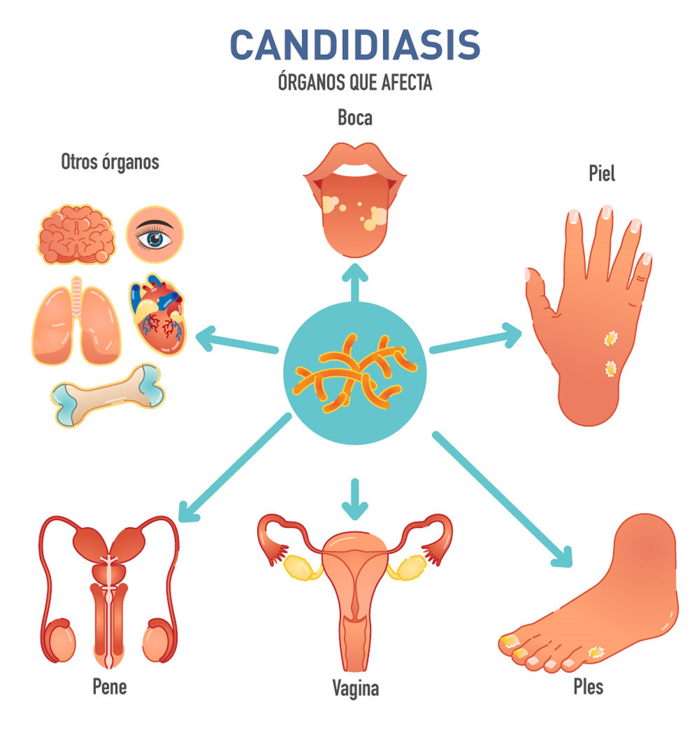 CANDIDIASIS FUNGUS KILLER - Prevent and Treat