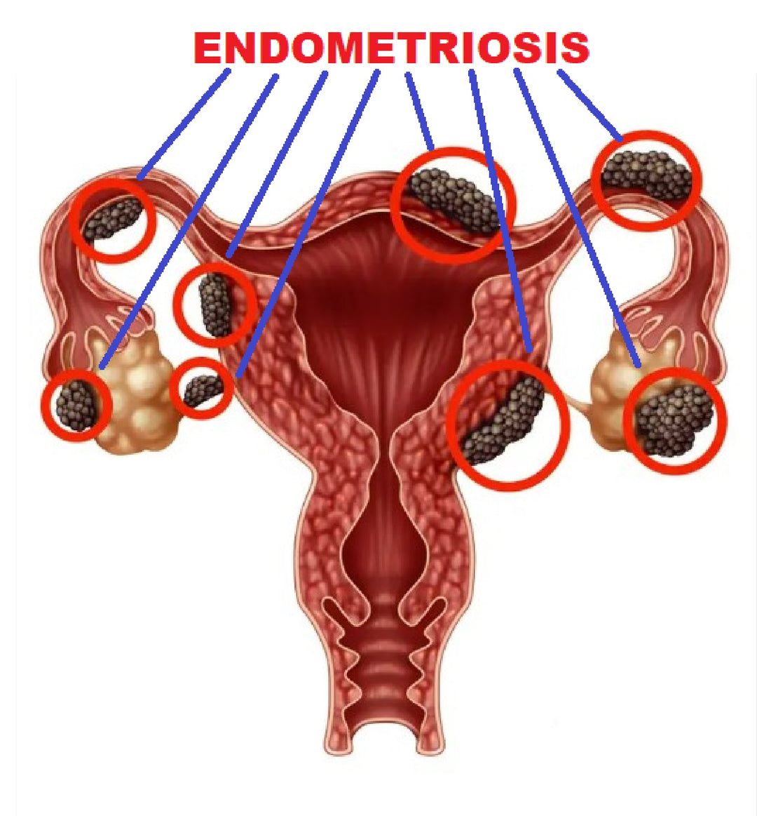 STOP THE ENDOMETRIOSIS PAIN RIGHT NOW - TREAT & PREVENT - 100% NATURAL - MADE IN USA
