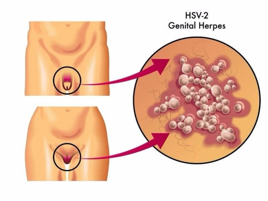 GET RID OF HERPES SIMPLEX 1 & 2 -Herpes-Virus-Defense - VAGINAL EYES and BUCAL - MADE IN USA