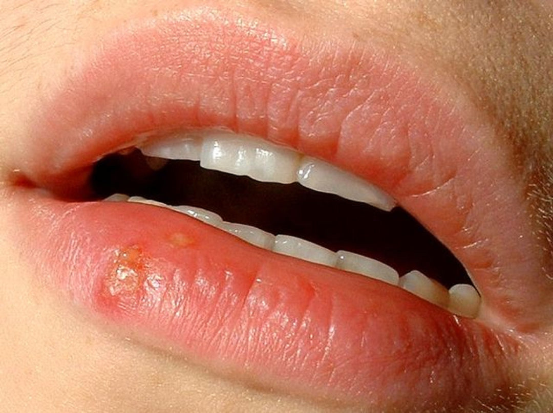 GET RID OF HERPES SIMPLEX 1 & 2 -Herpes-Virus-Defense - VAGINAL EYES and BUCAL - MADE IN USA
