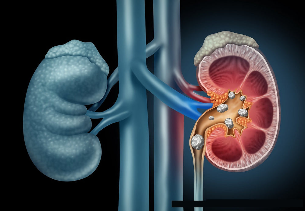 GET RID OF KIDNEY STONES NOW - GALLBLADDER STONE BREAKER to Treat & Prevent - MADE IN USA