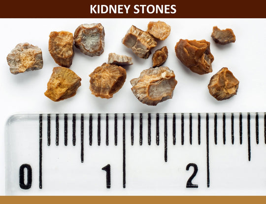 GET RID OF GALLBLADDER STONES GALLSTONES & KIDNEY STONES - To Treat & Prevent - MADE IN USA