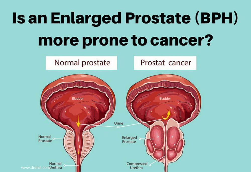 ENLARGED PROSTATE - BPH - to Treat and Prevent