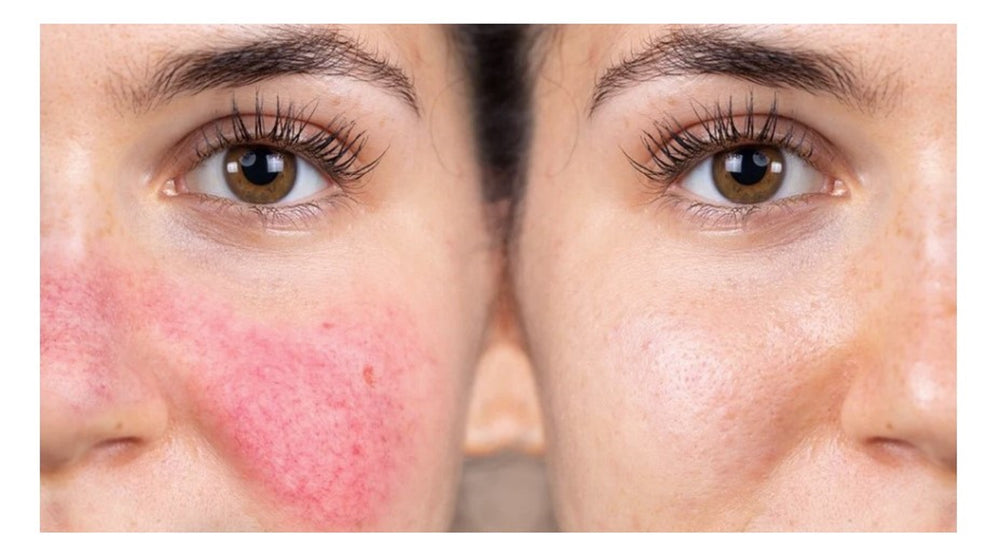 GET RID OF ECZEMA, ROSACEA & PSORIASIS NATURALLY - Prevent and Treat - MADE IN USA