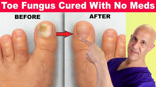 TOENAIL FUNGUS 4 ME - TO CURE, TREAT AND PREVENT