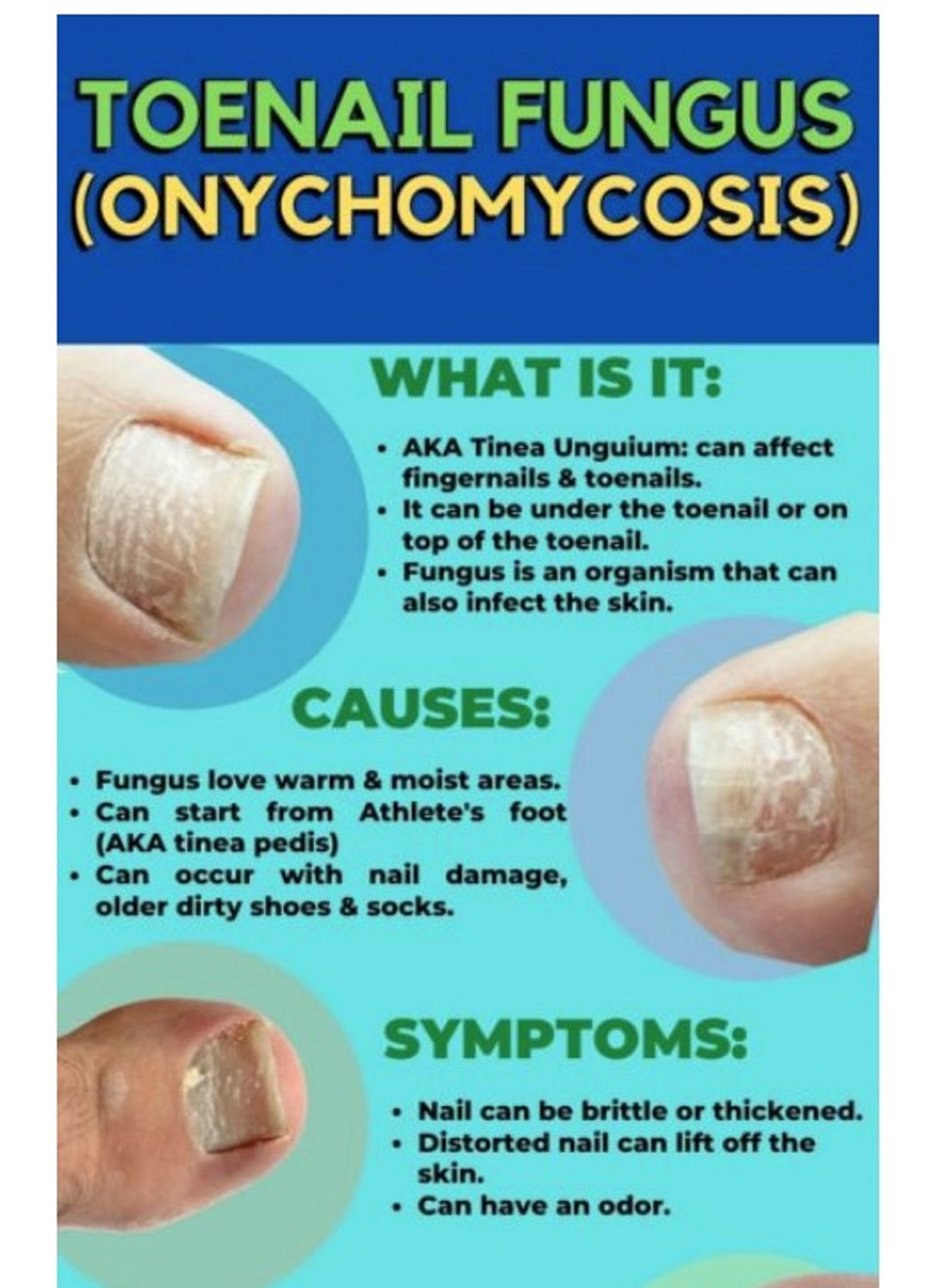 TOENAIL FUNGUS 4 ME - TO CURE, TREAT AND PREVENT