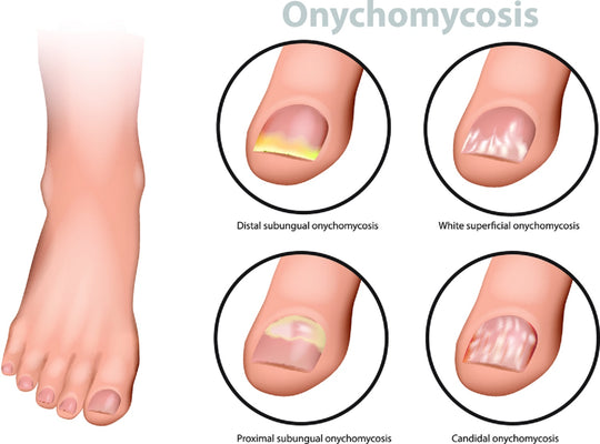 TOENAIL FUNGUS 4 ME - TO CURE, TREAT AND PREVENT