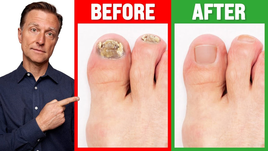 TOENAIL FUNGUS 4 ME - TO CURE, TREAT AND PREVENT