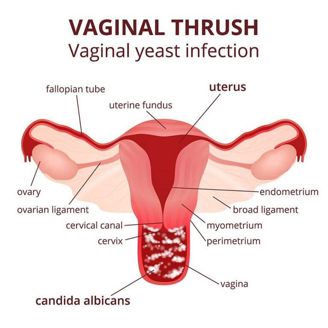 VAGINAL YEAST INFECTION - TO TREAT AND PREVENT