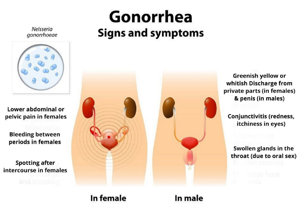 GONORRHEA 4 ME -  WOMEN & MEN - to Treat and Prevent