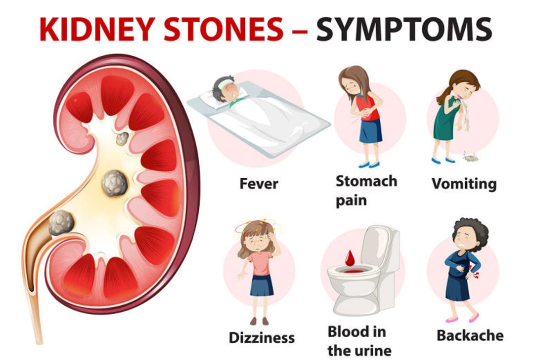 KIDNEY STONE BREAKER to Treat & Prevent