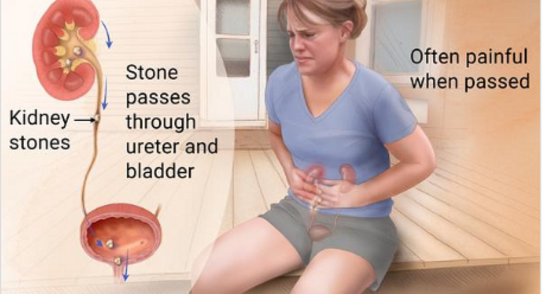 KIDNEY STONE BREAKER to Treat & Prevent